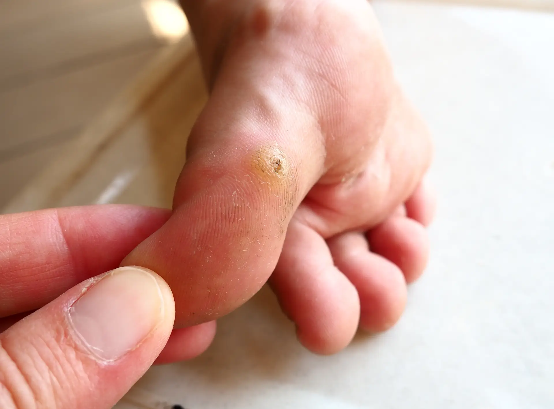 Recovery from Wart Removal Procedures