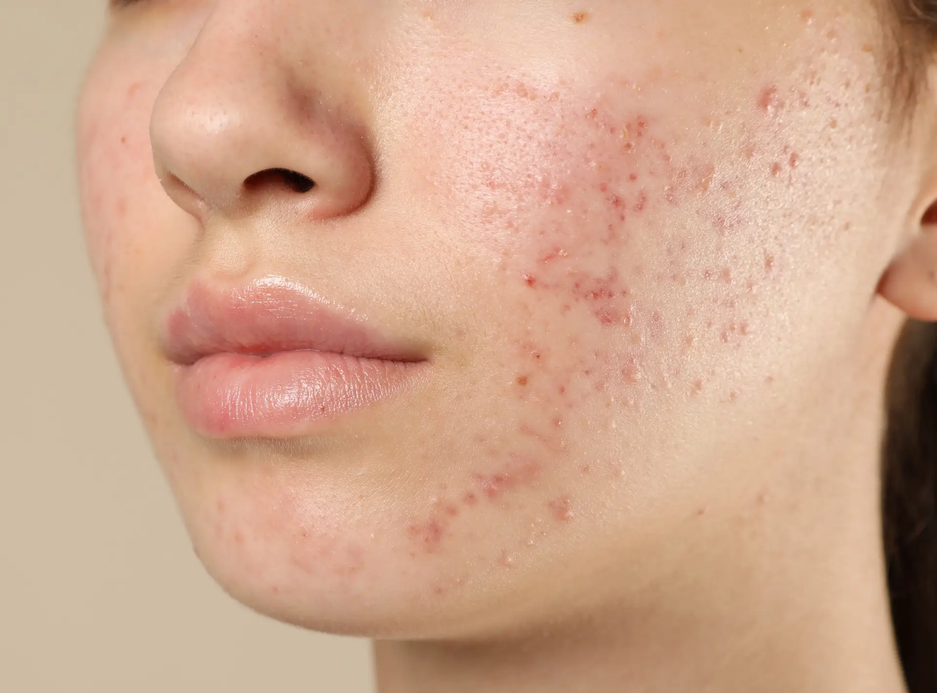 Types of Acne and Treatment Options
