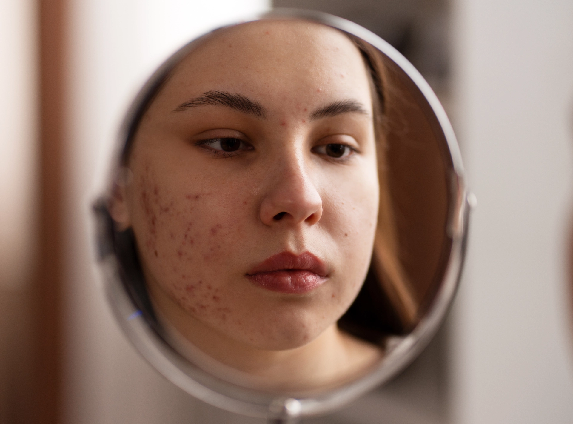How to Fade Acne Scars