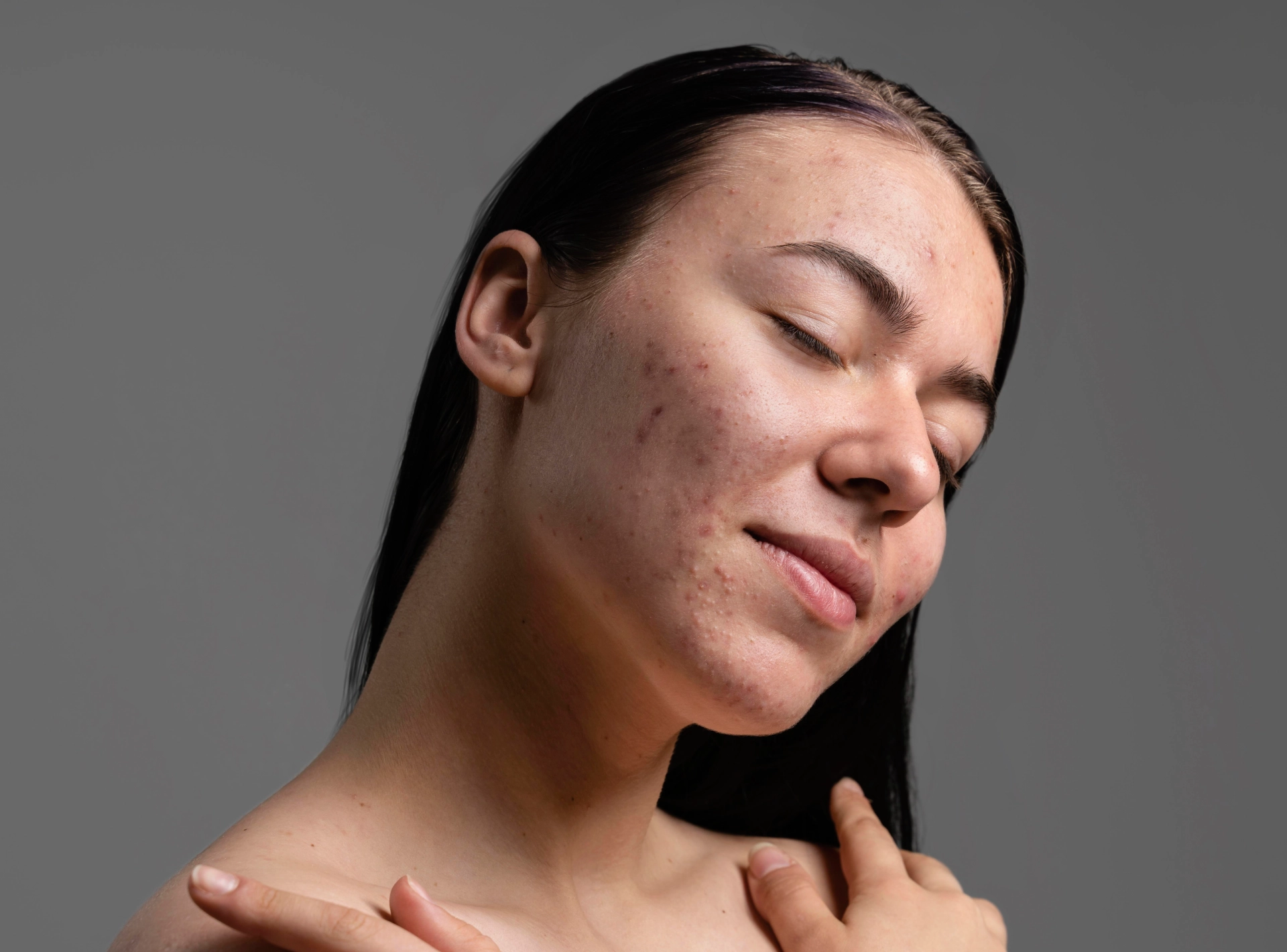 Everyday Things That May Be Causing Acne Breakouts