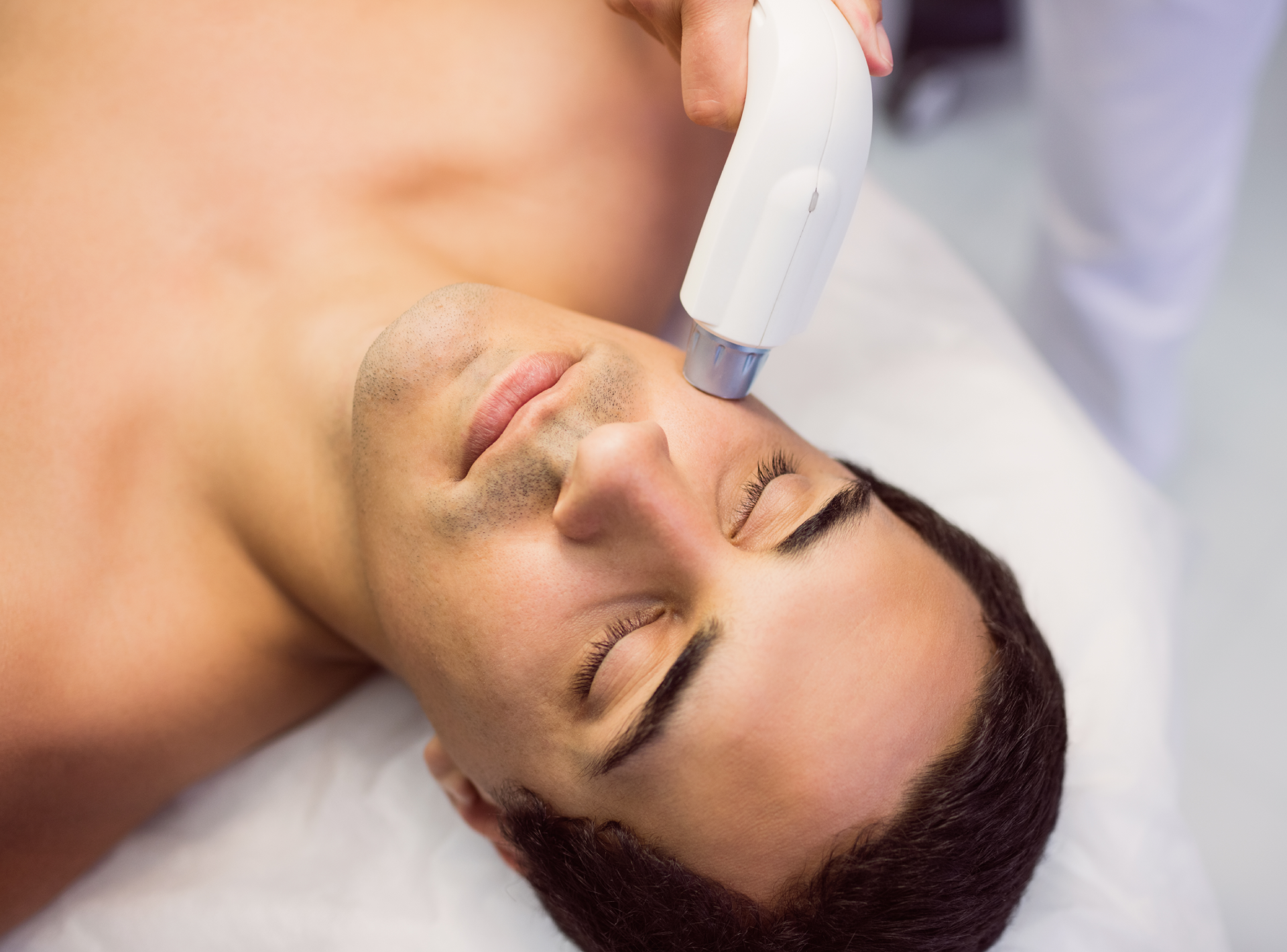 Beard Laser Hair Removal for Sensitive Skin