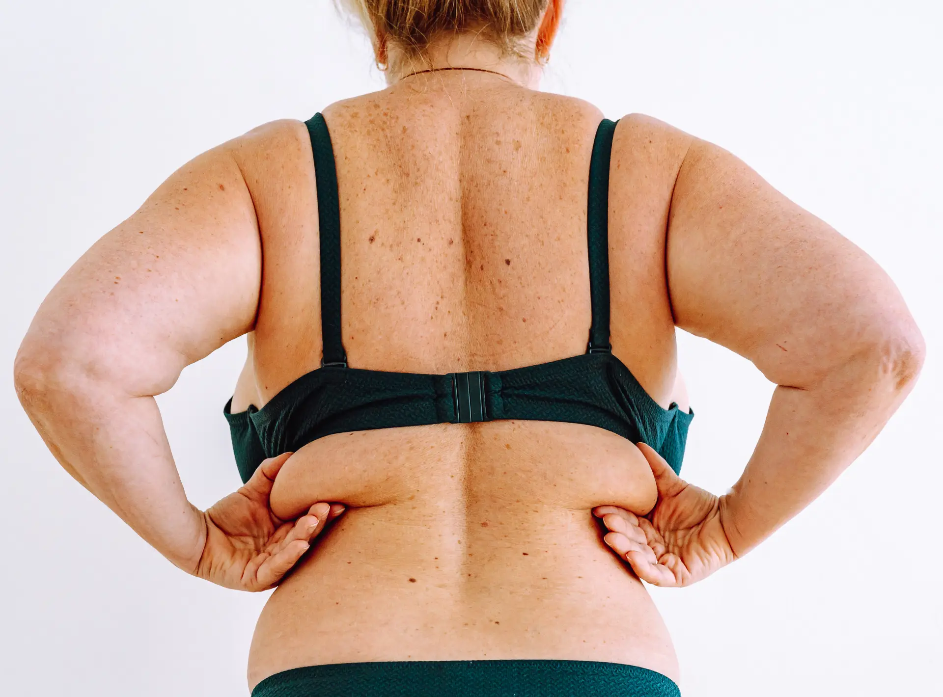 Results of a Bra Line Back Lift