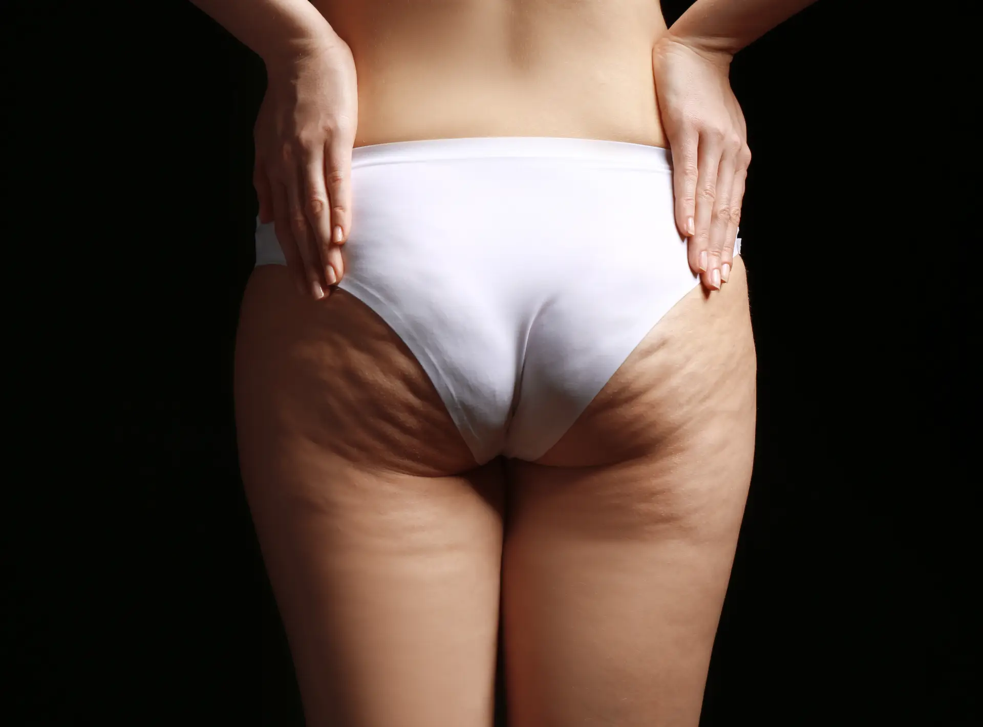 Cellulite (and How to Get Rid of It)