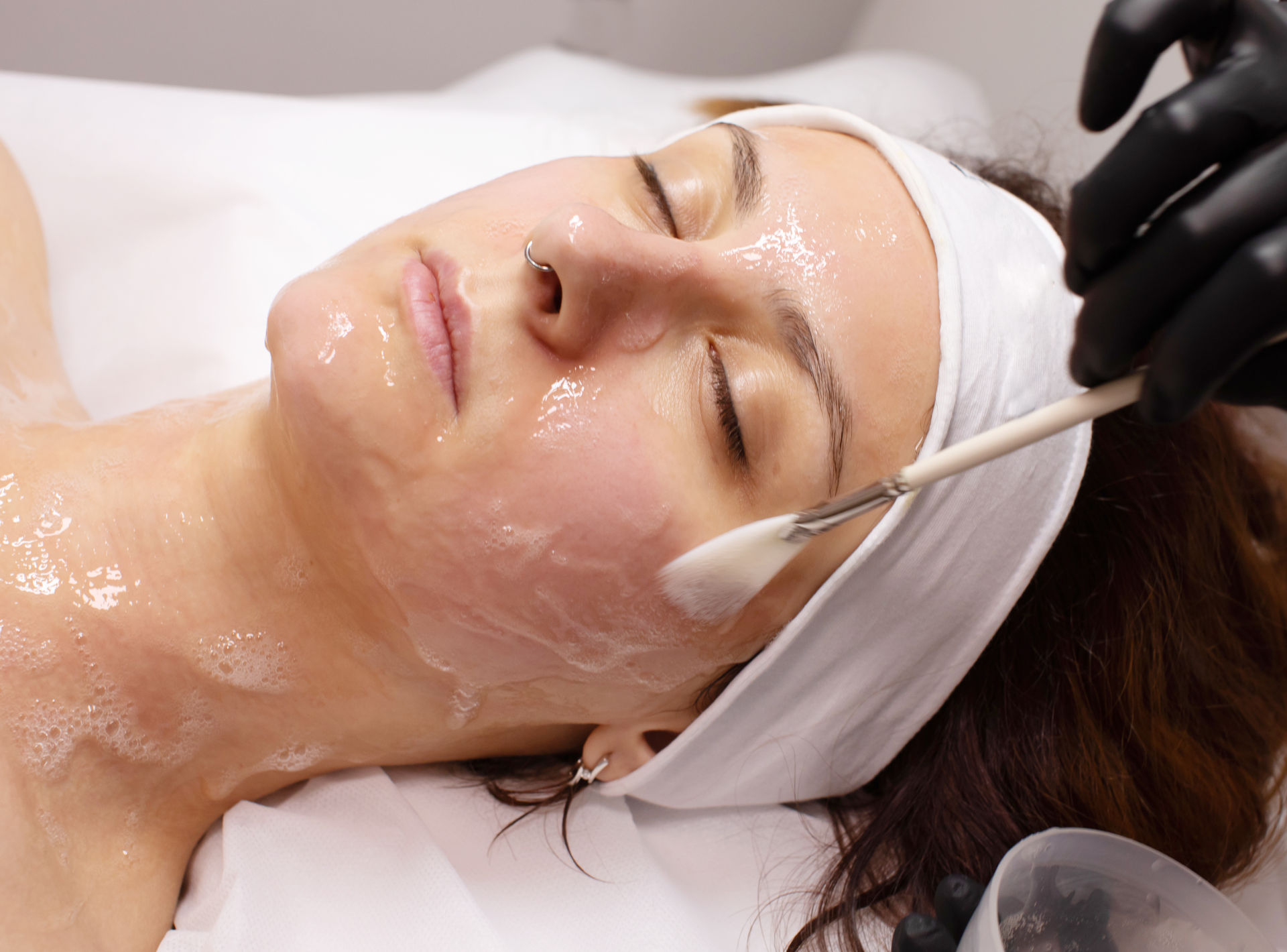 I Expect from a Chemical Peel