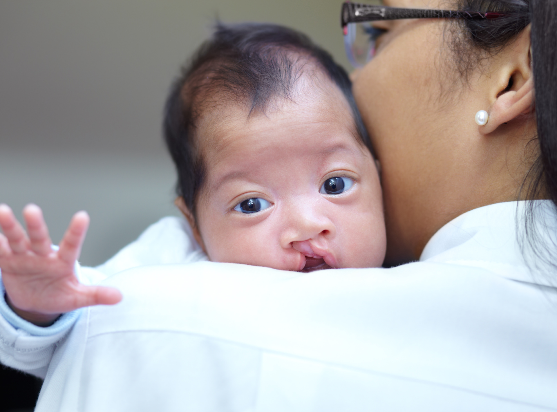 Cleft Lip and Cleft Palate Asked Questions