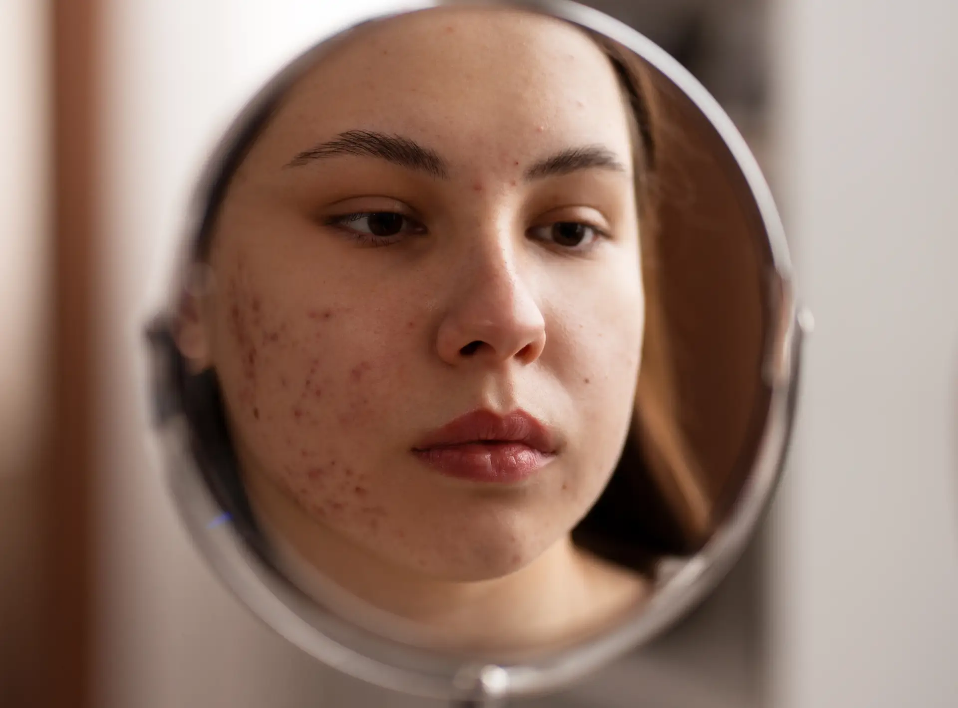 Diagnosing Acne: What Kind of Acne