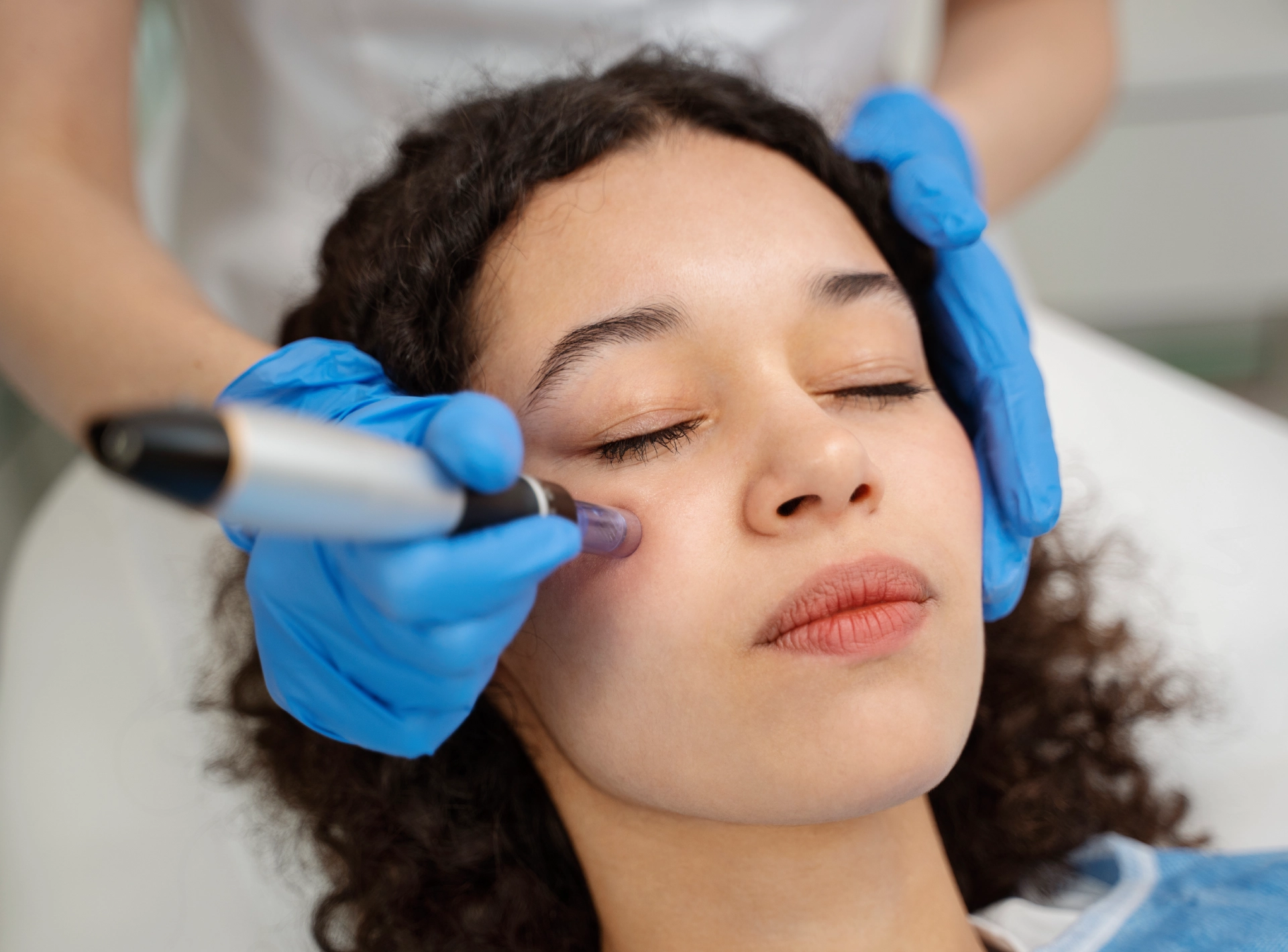Laser Vs Microneedling for Acne Scars