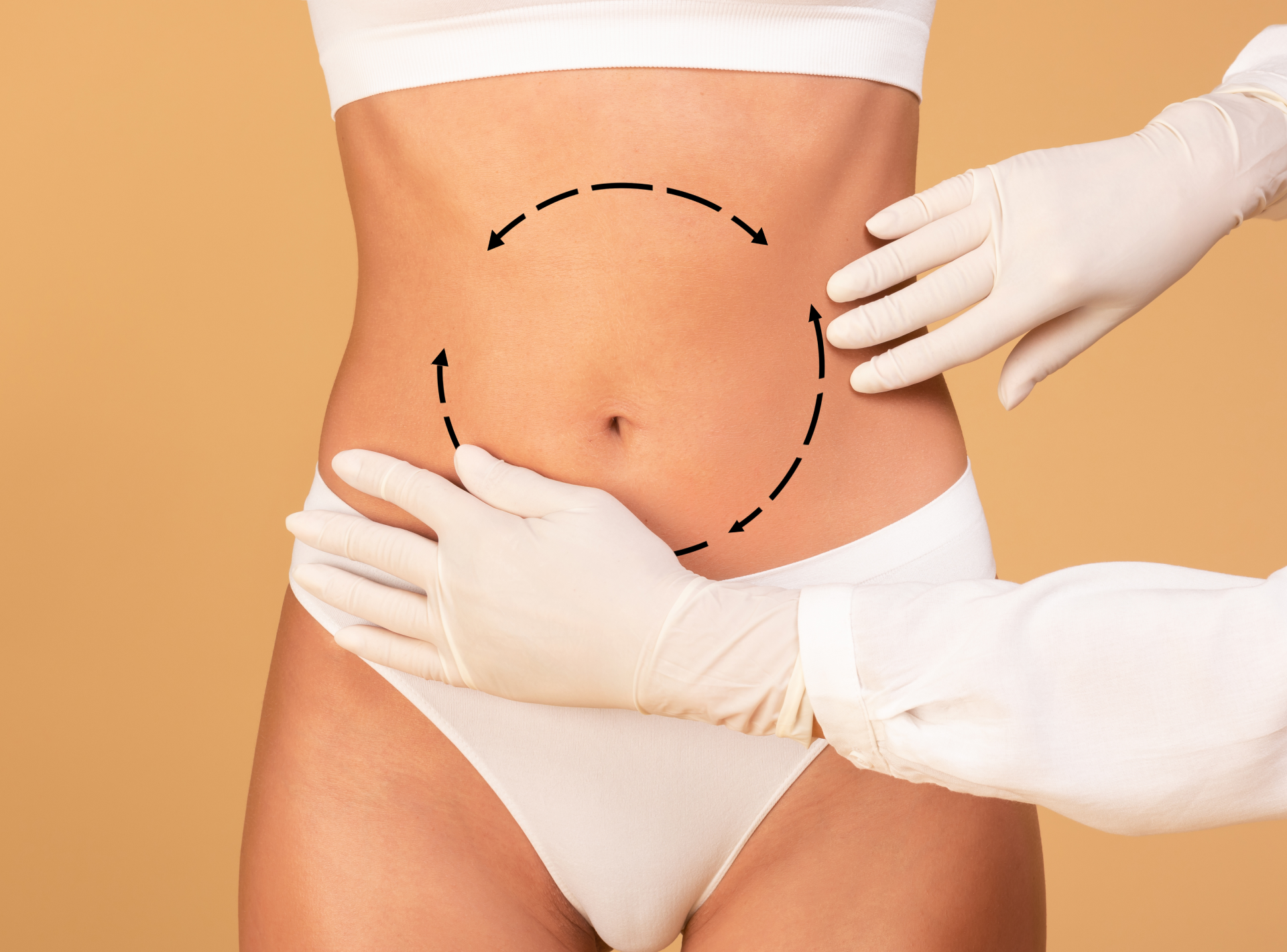 Tummy Tuck Procedure After a C-section