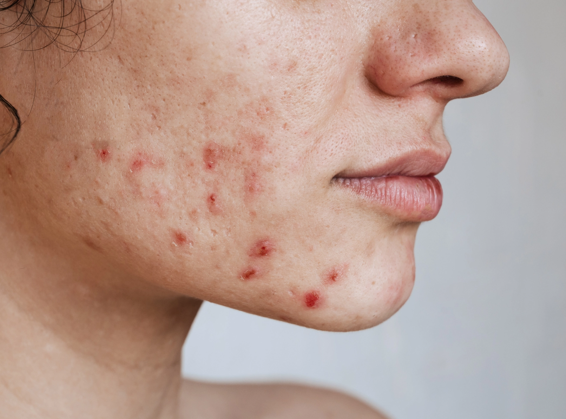 the Best Treatments for Each Type of Acne Scar