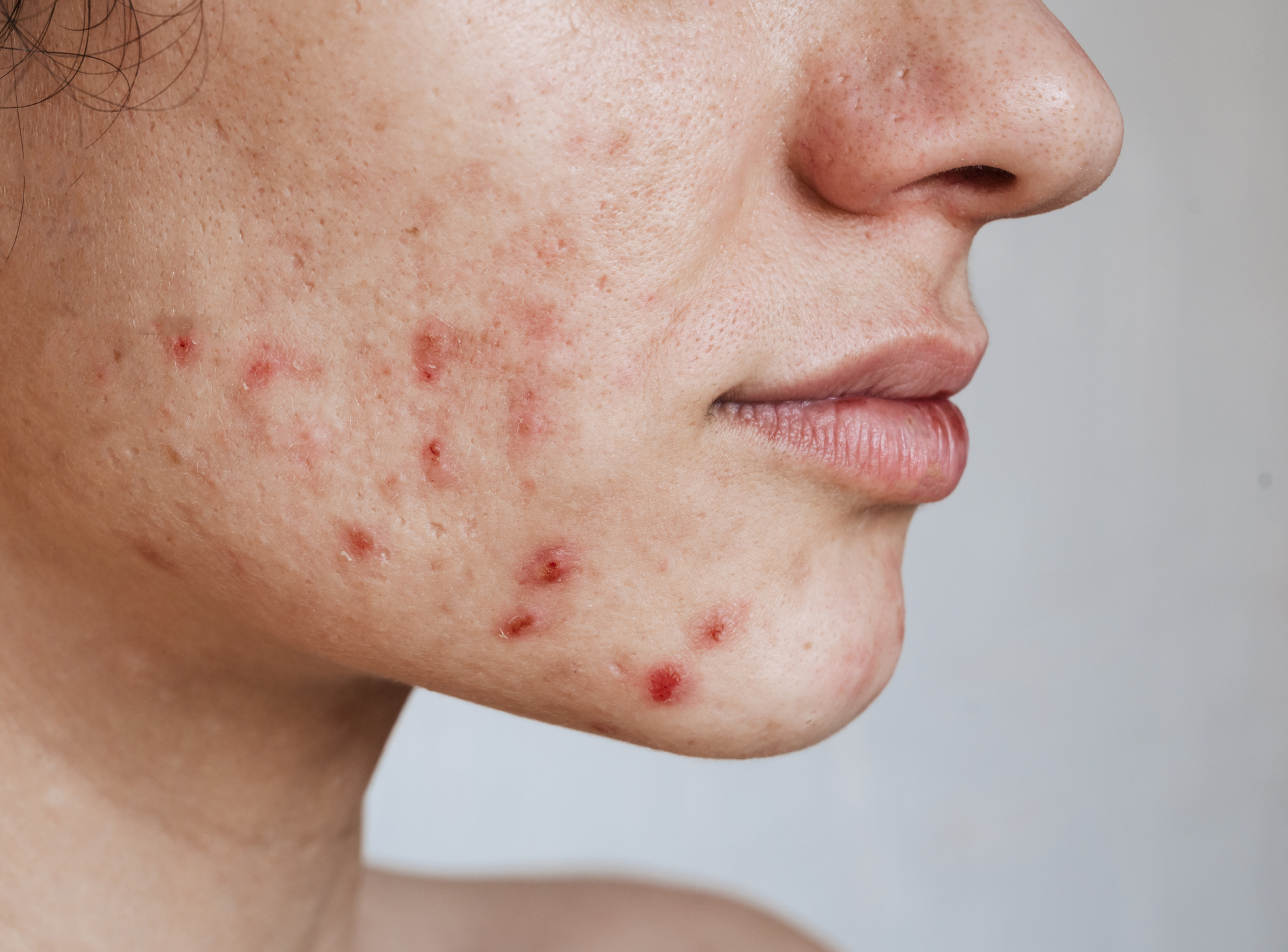 Quickly Get Rid of Acne Scars