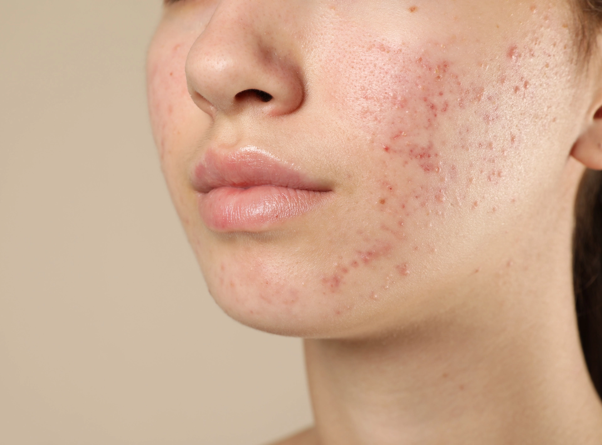 How to Prevent Acne Scars