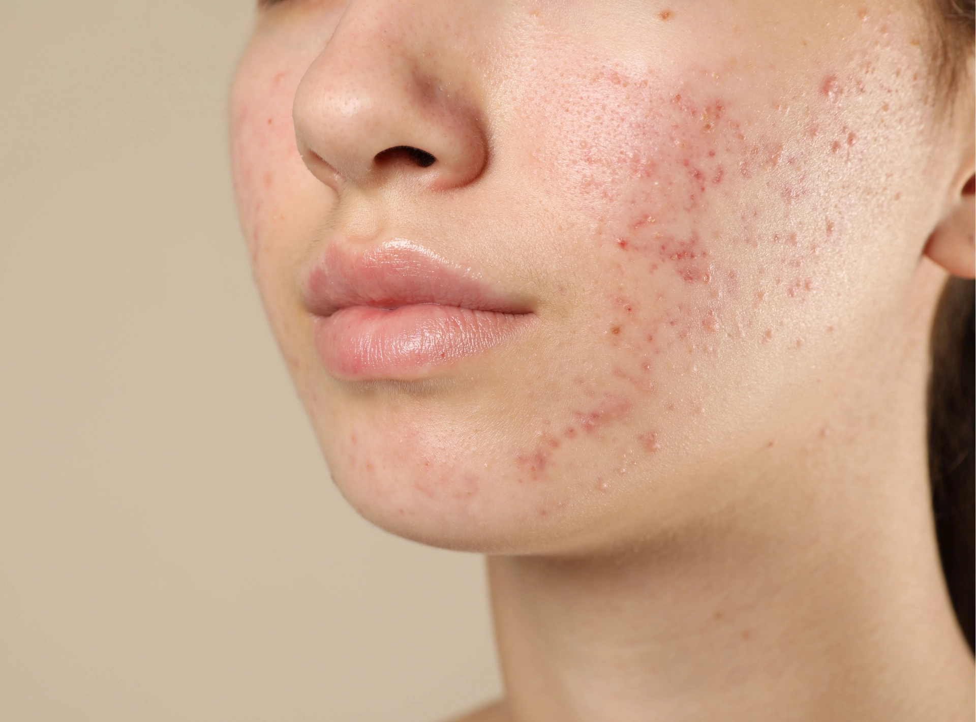 How to Get Rid of Acne Scars