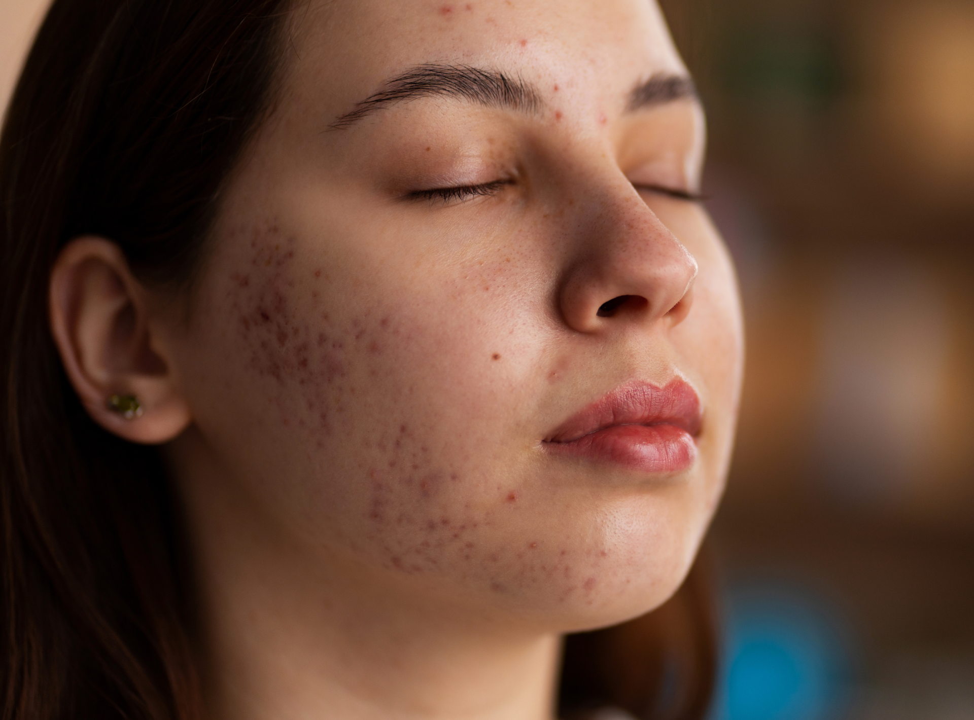 Goodbye to Acne