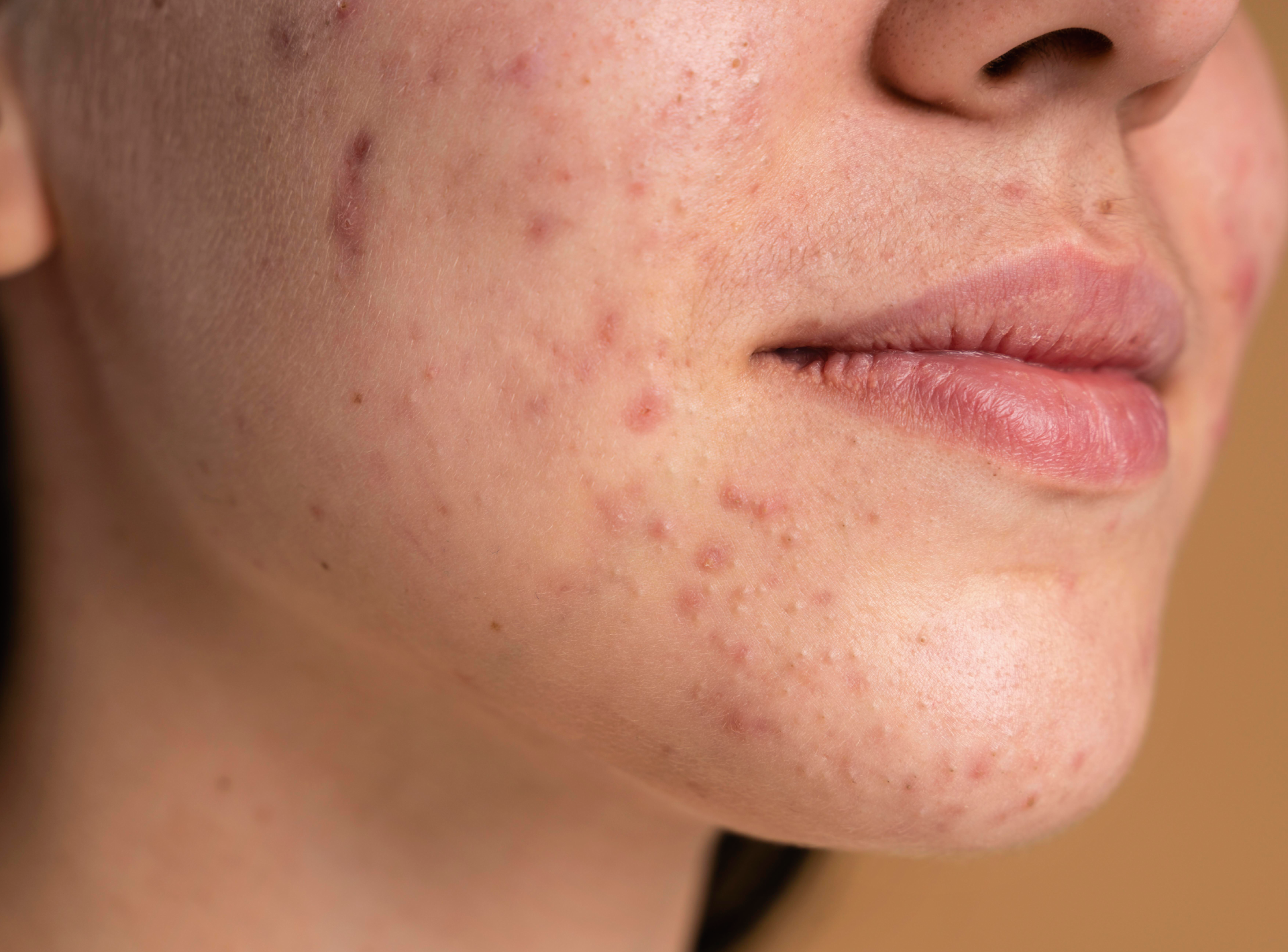 Your Acne is Tell You the Cause of Your Breakouts