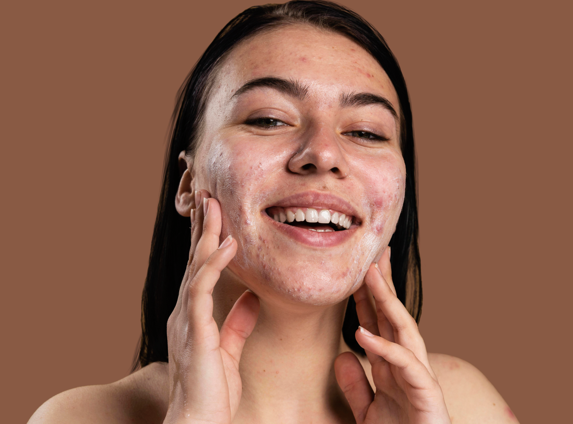 Results After My Acne Treatment