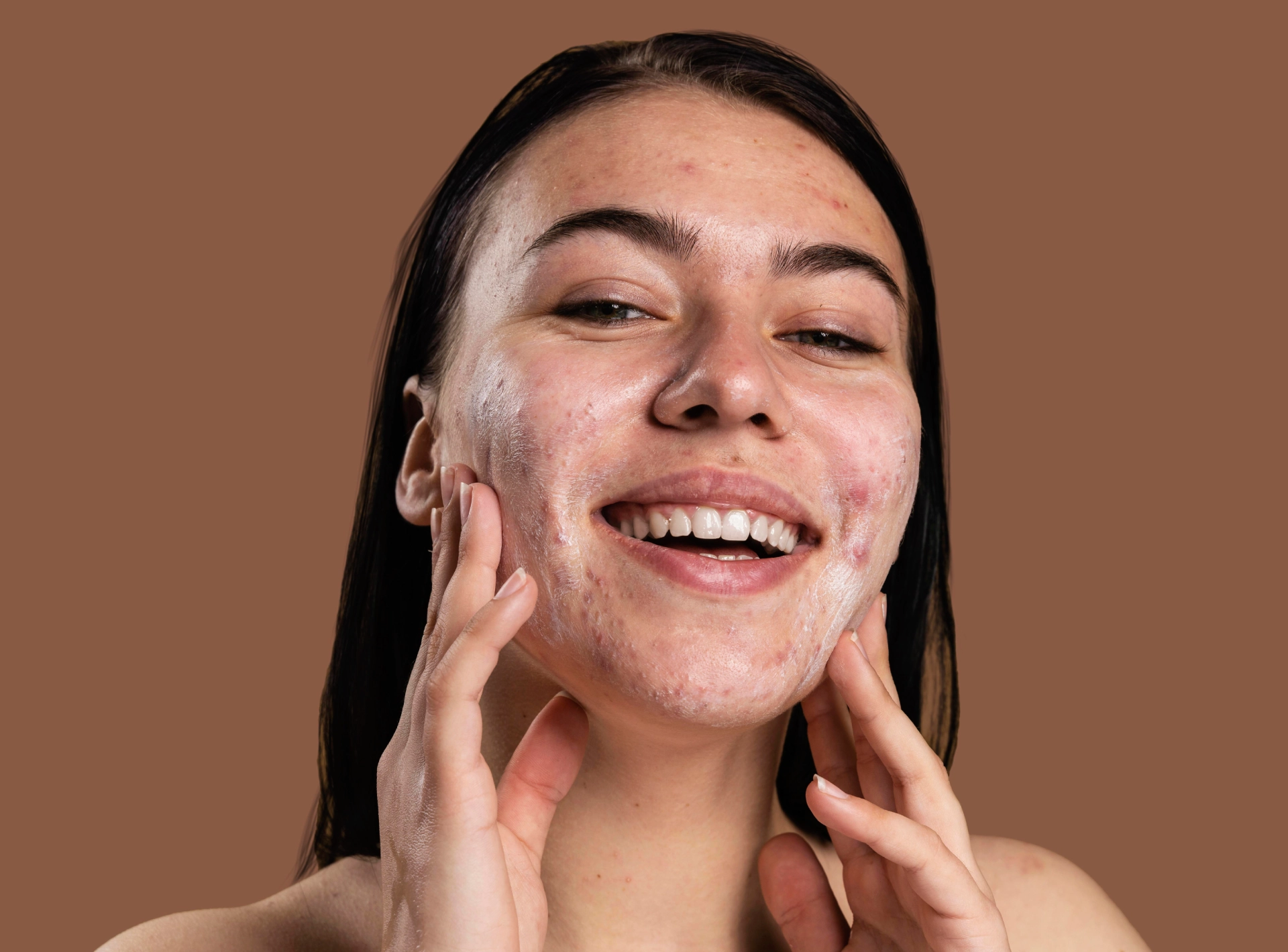 Next Generation Acne Treatments