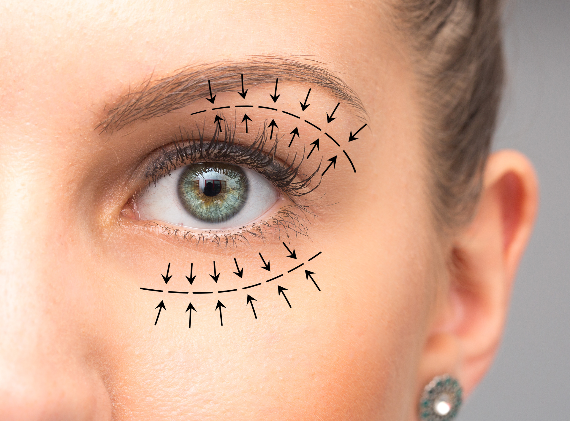 Easy to Hide Blepharoplasty Scars
