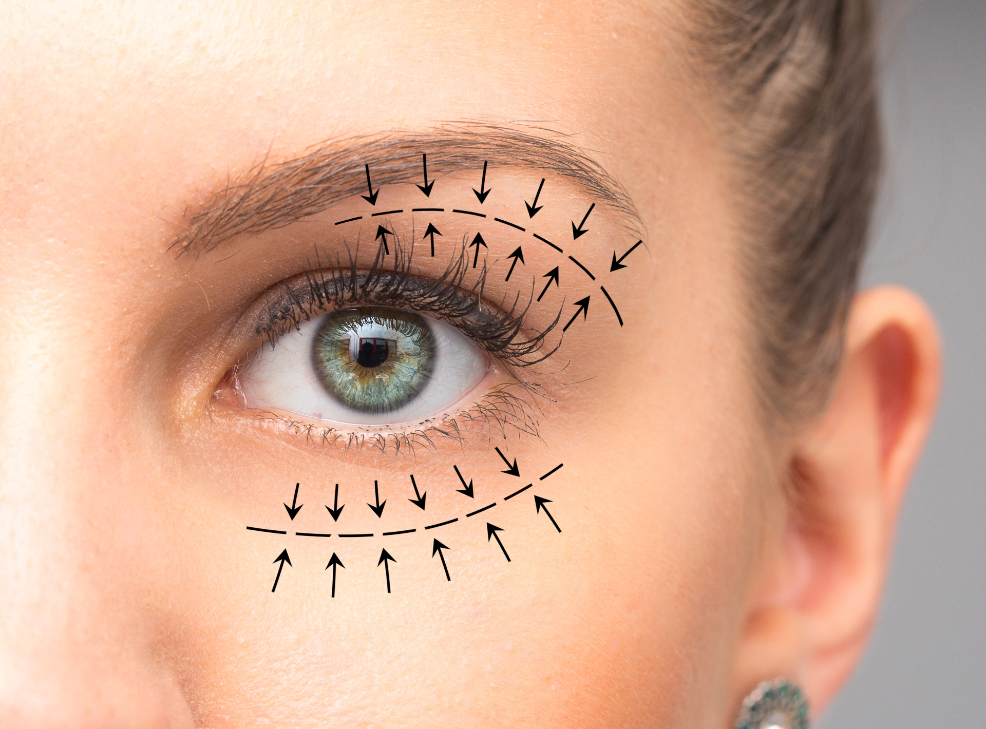 How Long Will My Blepharoplasty Results Last?