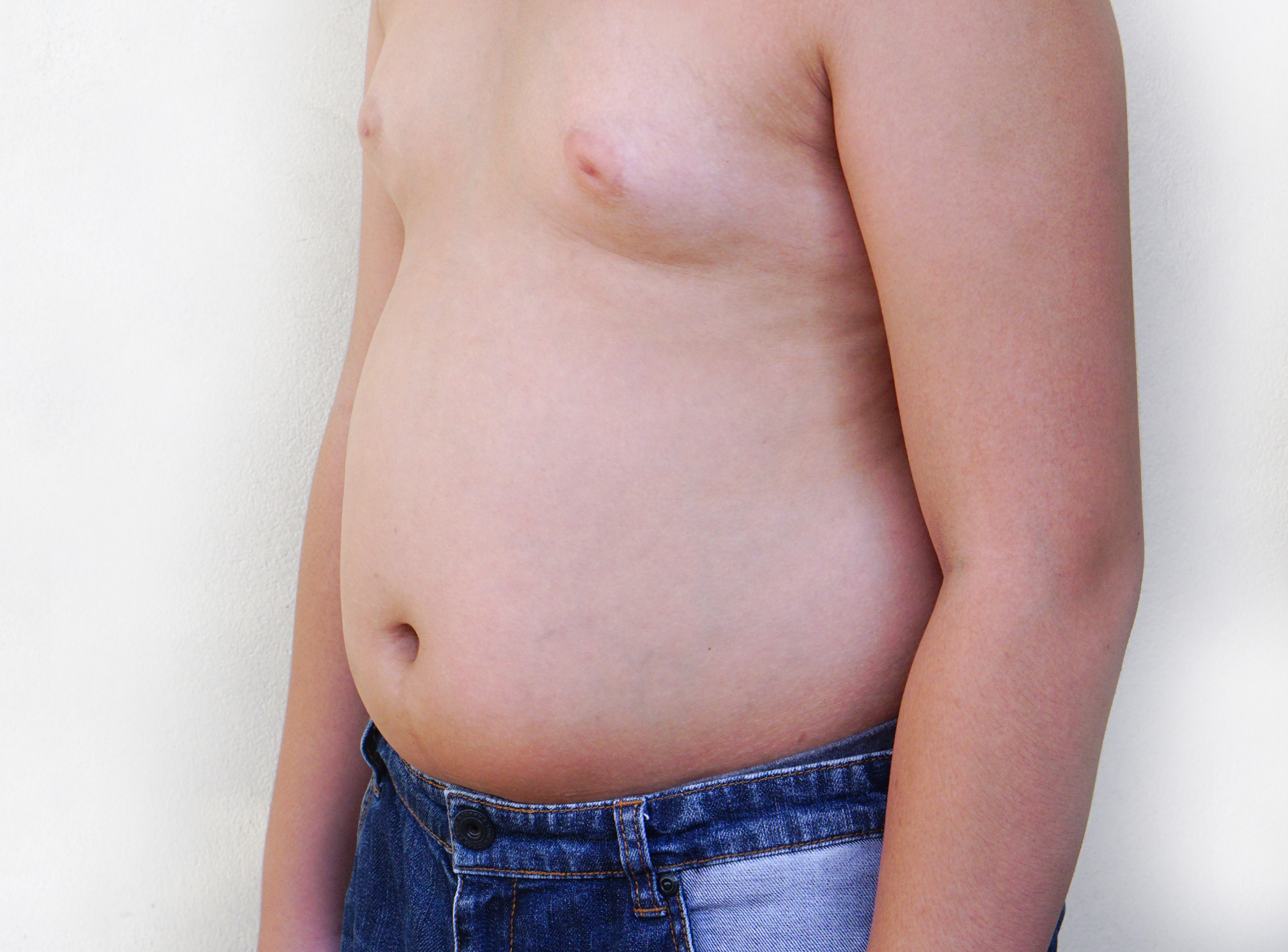 How Long Do Gynecomastia Surgery Results Last?