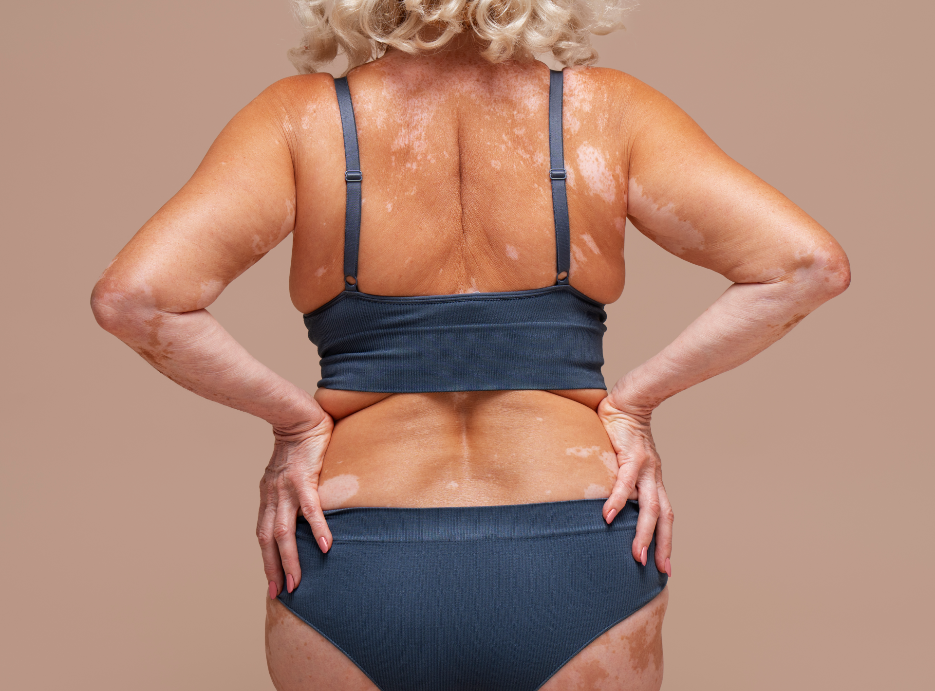 Get off My Back! Lipo for Bra Fat