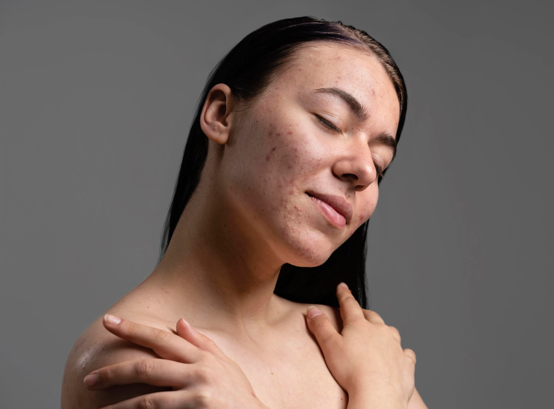 is Rf Microneedling Effective and Safe for Acne Scars?