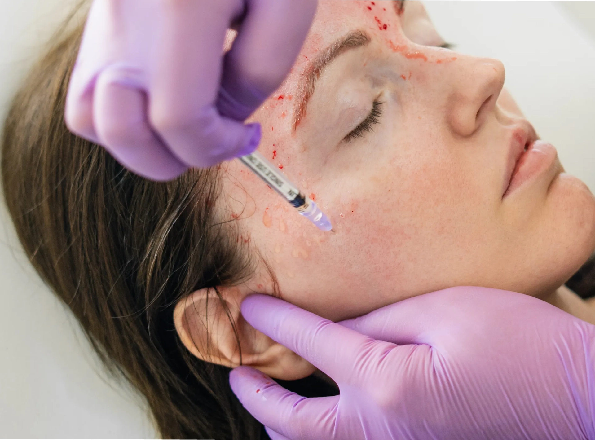 Addressing All of Your Questions About Vampire Facials