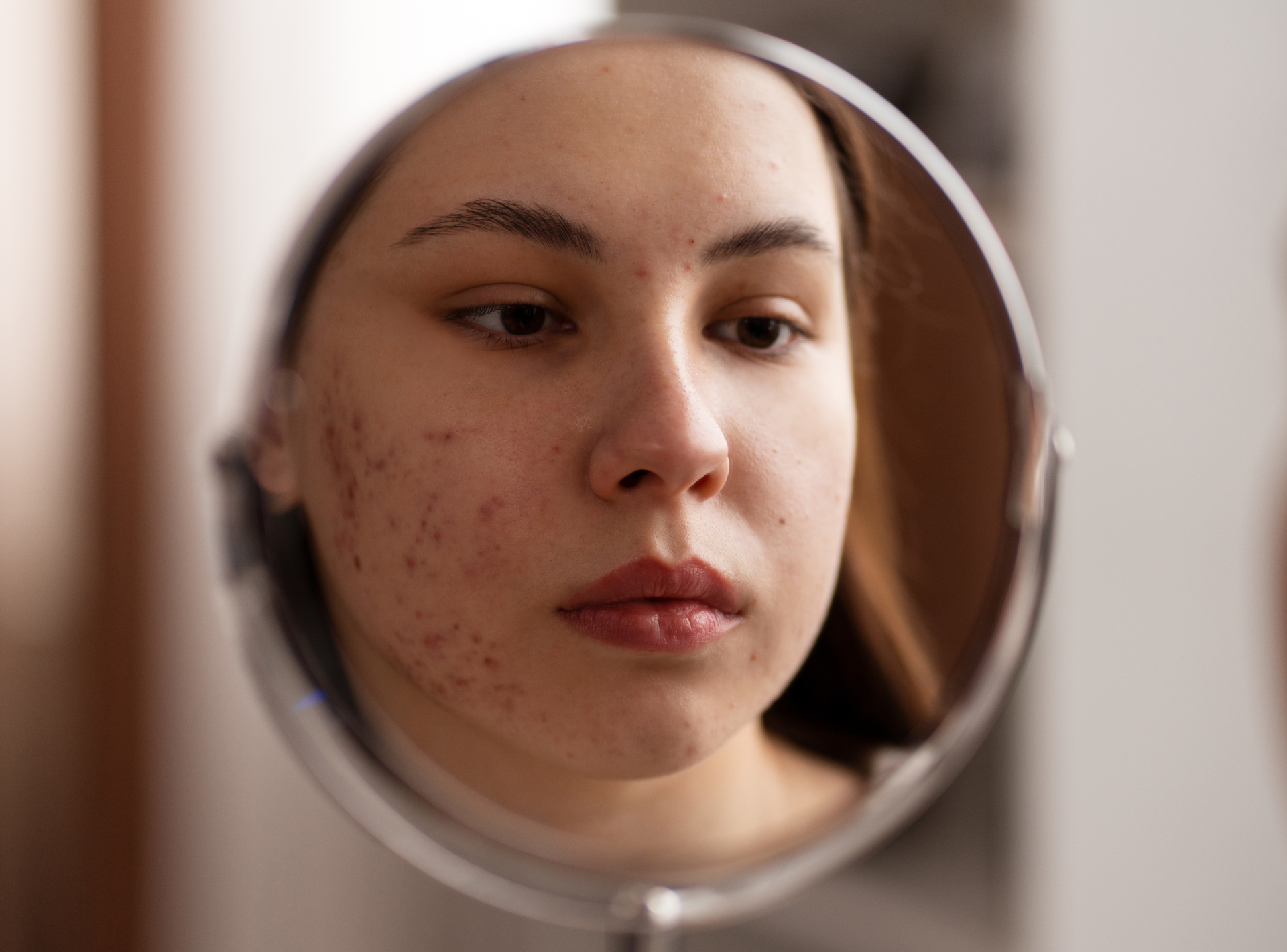 Acne Treatment for Teens and Adults