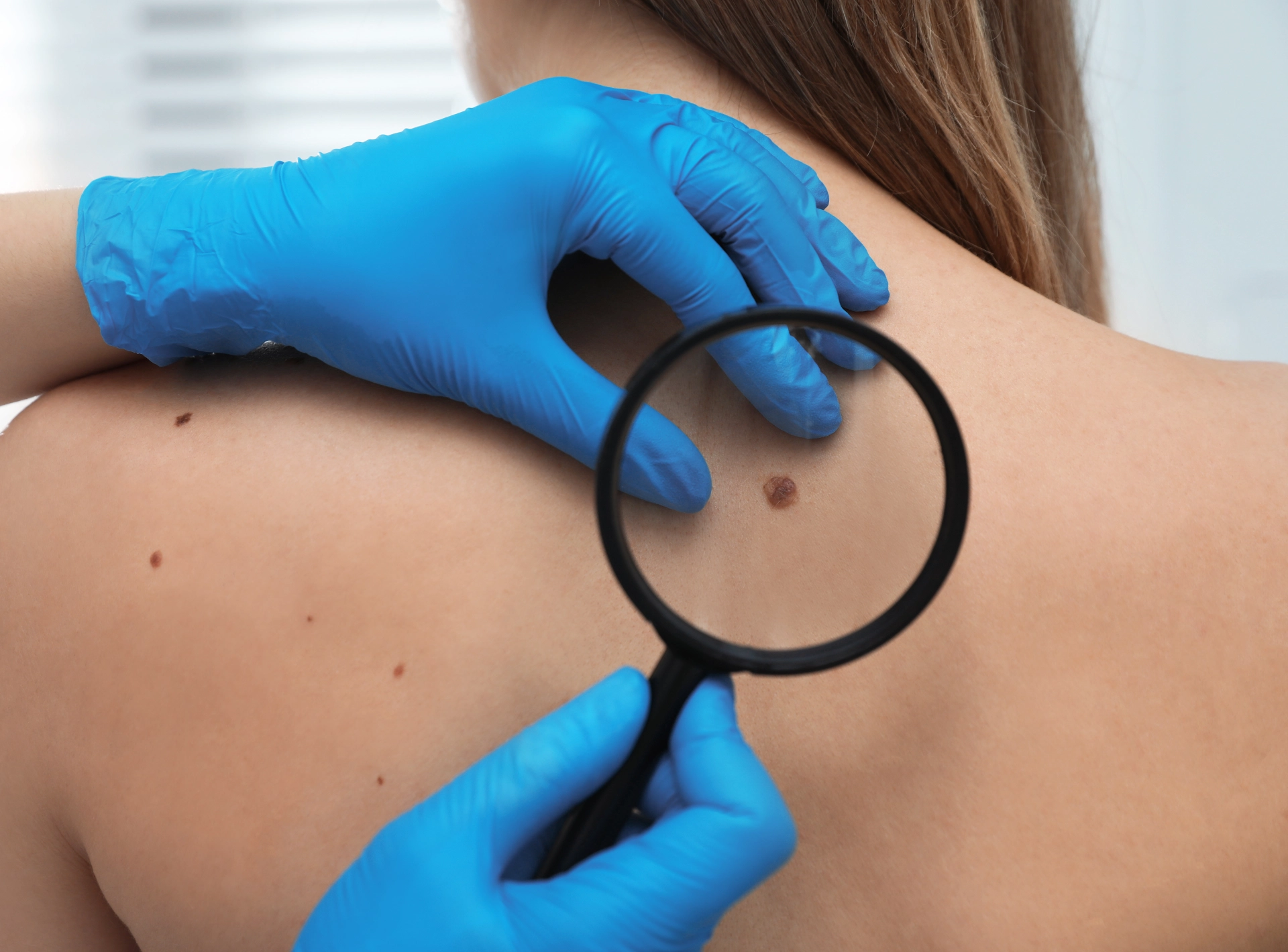 ​​will Mole Removal Leave a Scar?