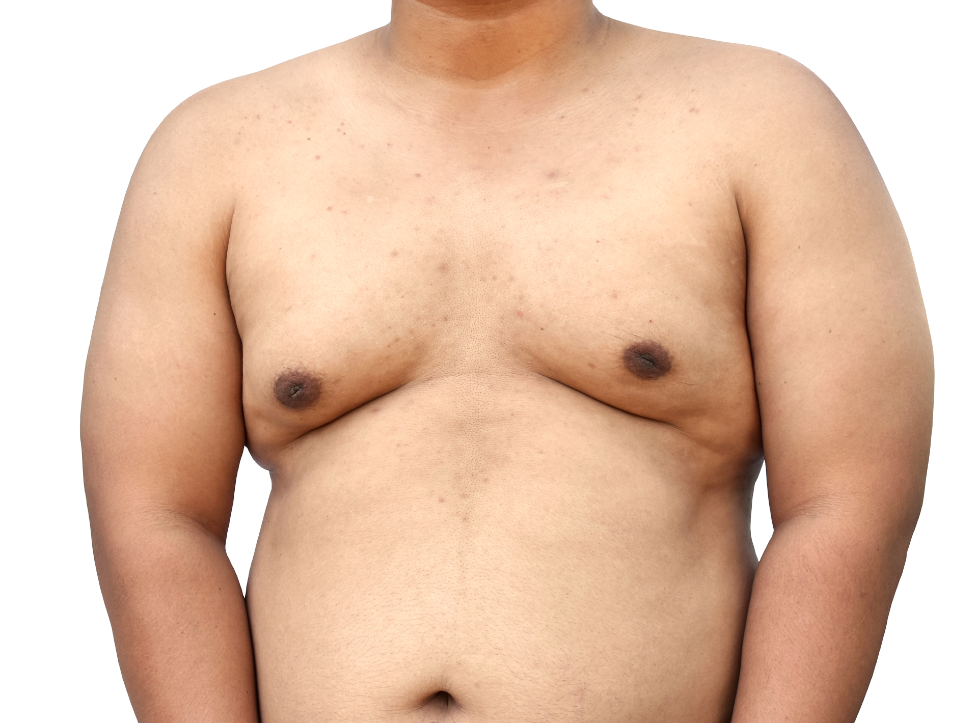 Get Rid of Puffy Nipples