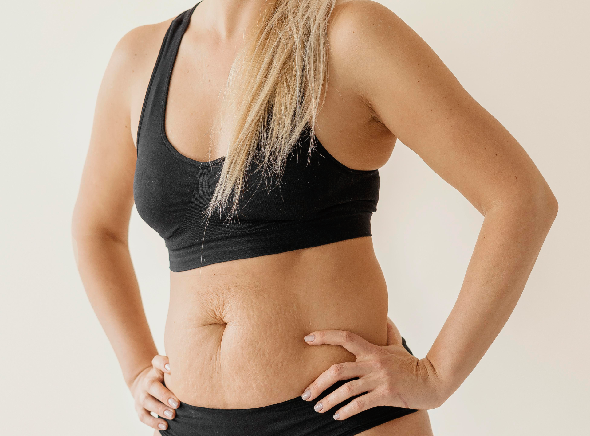 Tummy Tuck After Pregnancy