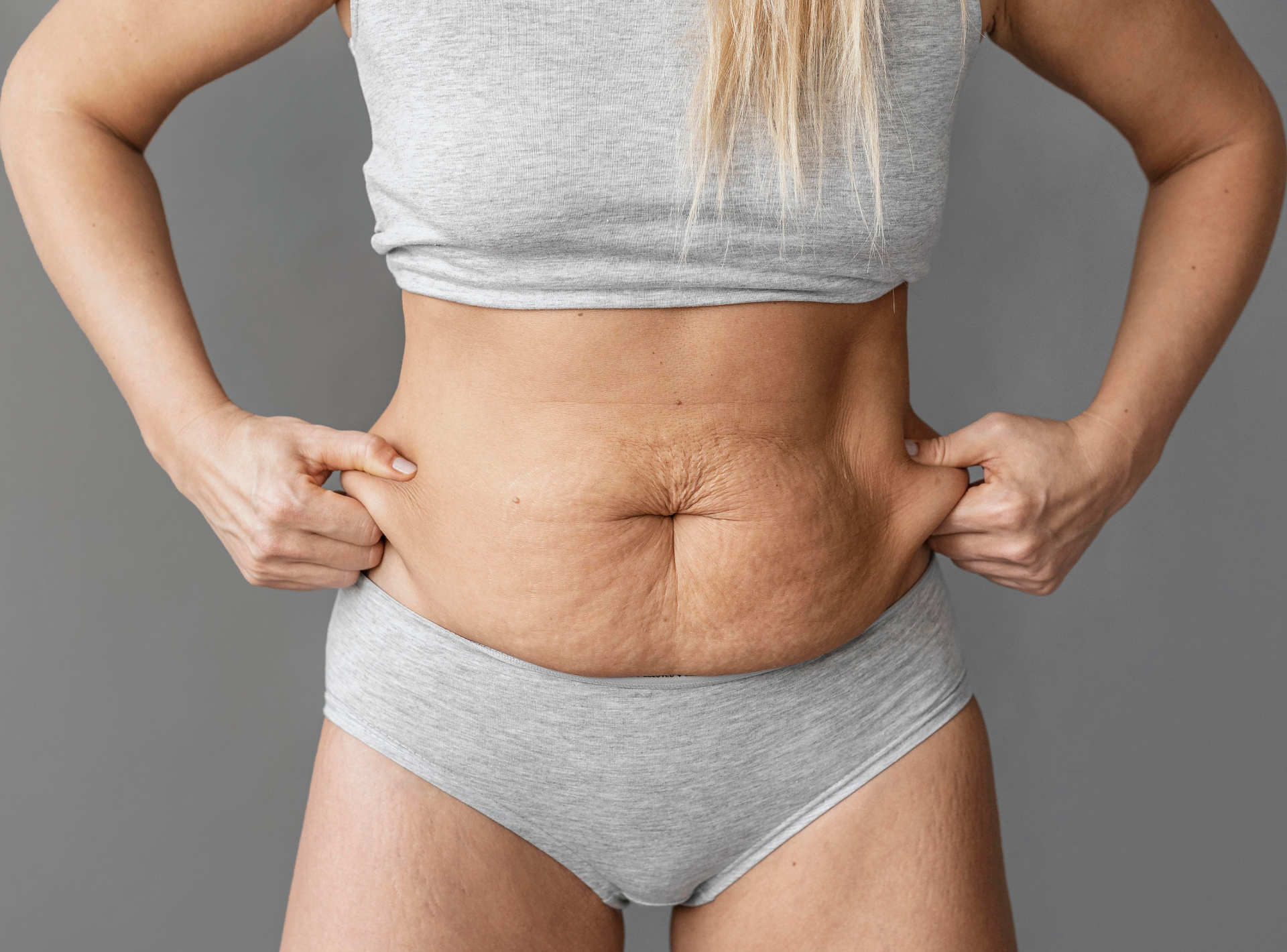 Tummy Tuck Results for Weight Loss?